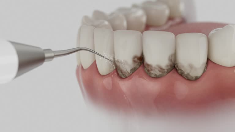 Trusted Dental Implants service in Edgewater, MD - Dentist Open Now